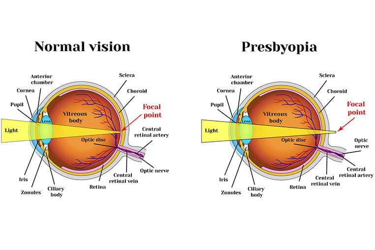 Presbiopia